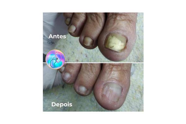 Foto de antes e depois do tratamento 39